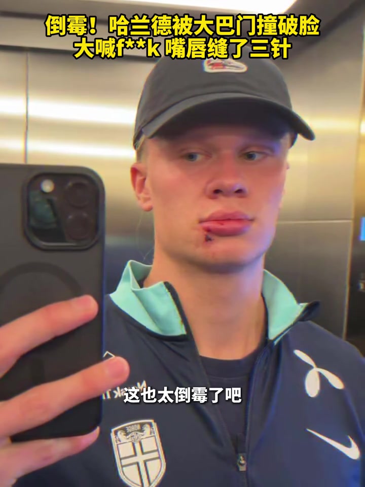 嘴角缝了三针哈兰德被大巴车门撞破脸现场大喊Fxxk